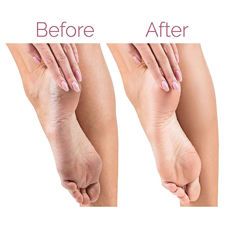 Electric Pedicure Foot File Callus Remover, Rechargeable Foot File Pedicure Foot